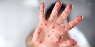 Creches com crianças sintomáticas de “mão-pé-boca” devem ser reabertas em Ouro Preto