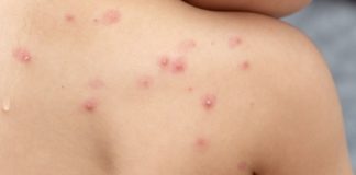 Caso de “varíola dos macacos’” em Ouro Preto é descartado