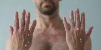 1º caso da varíola dos macacos é confirmado em Itabirito, afirma Prefeitura