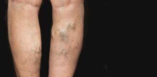 Tratamento inovador para os portadores de varizes é realidade na rede pública de Ouro Preto Tratamento contra varizes em Ouro Preto pelo SUS. Foto - THINKSTOCK