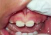 Congonhas: mãe pede ajuda para tratar filho, de quase 2 anos, que sofre de má-formação dos dentinhos Má-formação dos dentinhos de Lorran. Foto - Divulgação