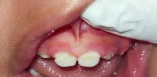 Congonhas: mãe pede ajuda para tratar filho, de quase 2 anos, que sofre de má-formação dos dentinhos Má-formação dos dentinhos de Lorran. Foto - Divulgação