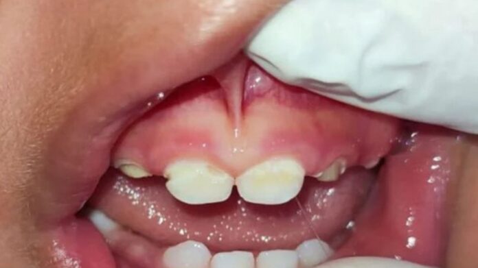 Má-formação dos dentinhos de Lorran. Foto - Divulgação