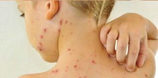 Itabirito amplia vacinação contra catapora Manifestação da catapora. Foto - Reprodução
