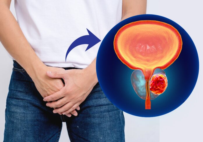Professora da Alis Itabirito: “Câncer de próstata em estágios iniciais tem chances de cura”