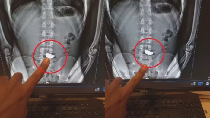 BH: após cortar tornozeleira eletrônica, jovem é preso por roubar e engolir corrente de R$ 20 mil