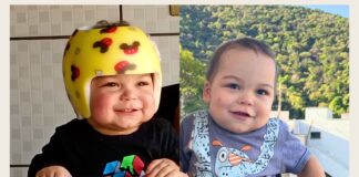 Itabirito: João Miguel, de 1 ano, vence má-formação craniana e se livra do capacete ortopédico De Itabirito, menino de 1 ano conclui tratamento contra má-formação craniana