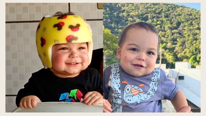 De Itabirito, menino de 1 ano conclui tratamento contra má-formação craniana